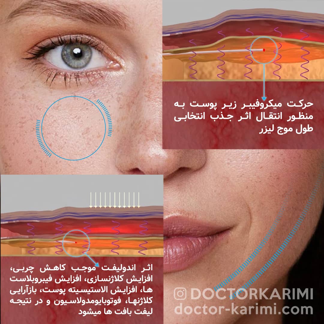 mechanism of action fo endolift by dr maryam karimi