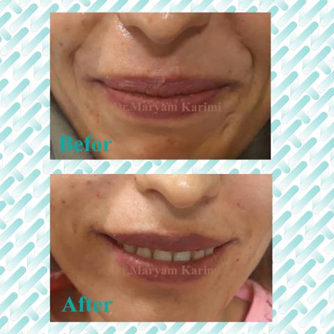 smile line fillers injection