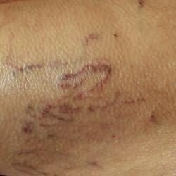 Spider veins