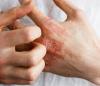 eczema