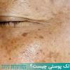 Hyperpigmentation & Dark Spots Treatments