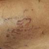 Spider veins