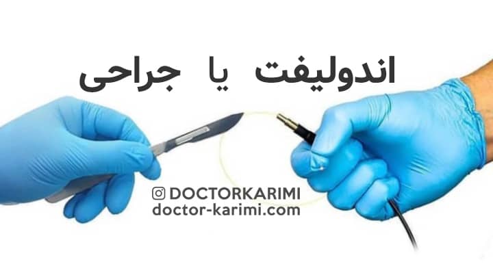 comparison of endolift vs surgery